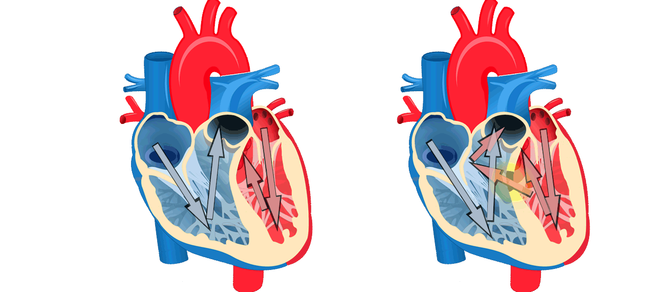 Largest genomic study of heart disease in children reveals inherited