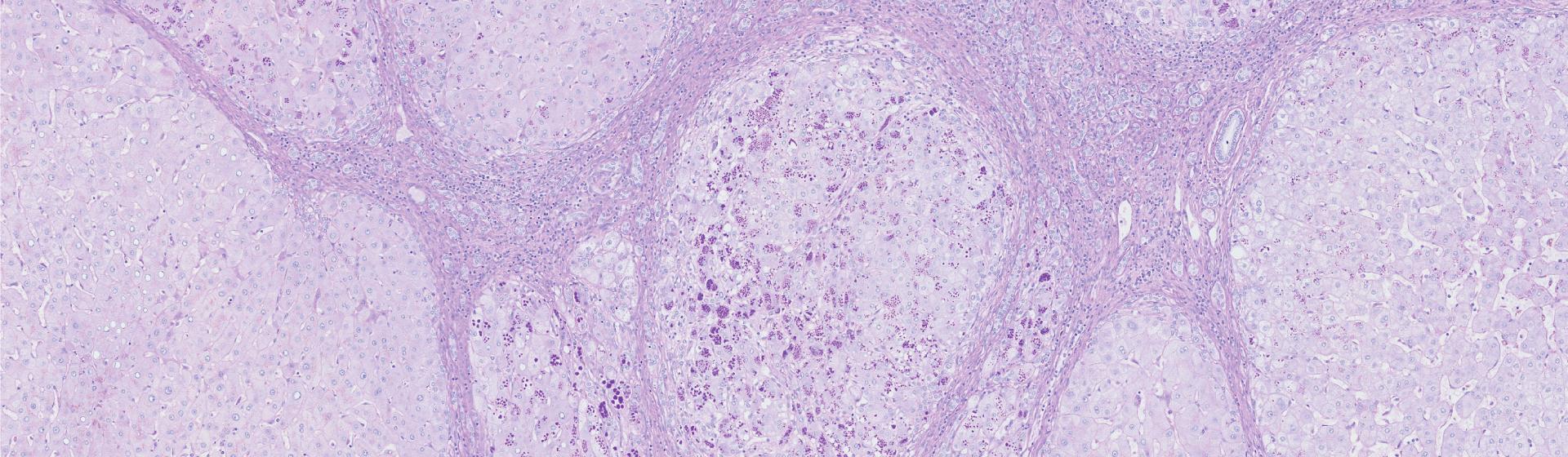 Liver histology with alpha-1 antitrypsin globules / Wellcome Sanger Institute