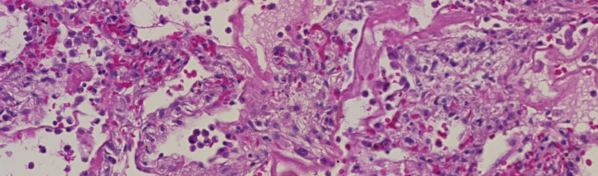 Early Diffuse Alveolar Damage / Wellcome Sanger Institute