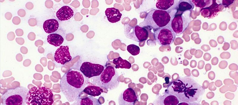 Unforeseen new drug target discovered for acute myeloid leukaemia (AML)